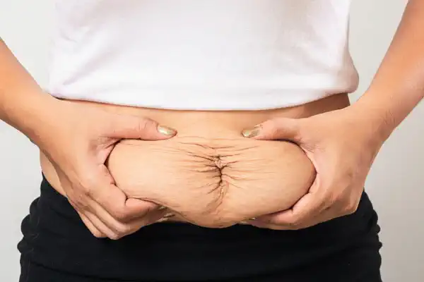 Who is a Good Candidate for Gastric Sleeve?